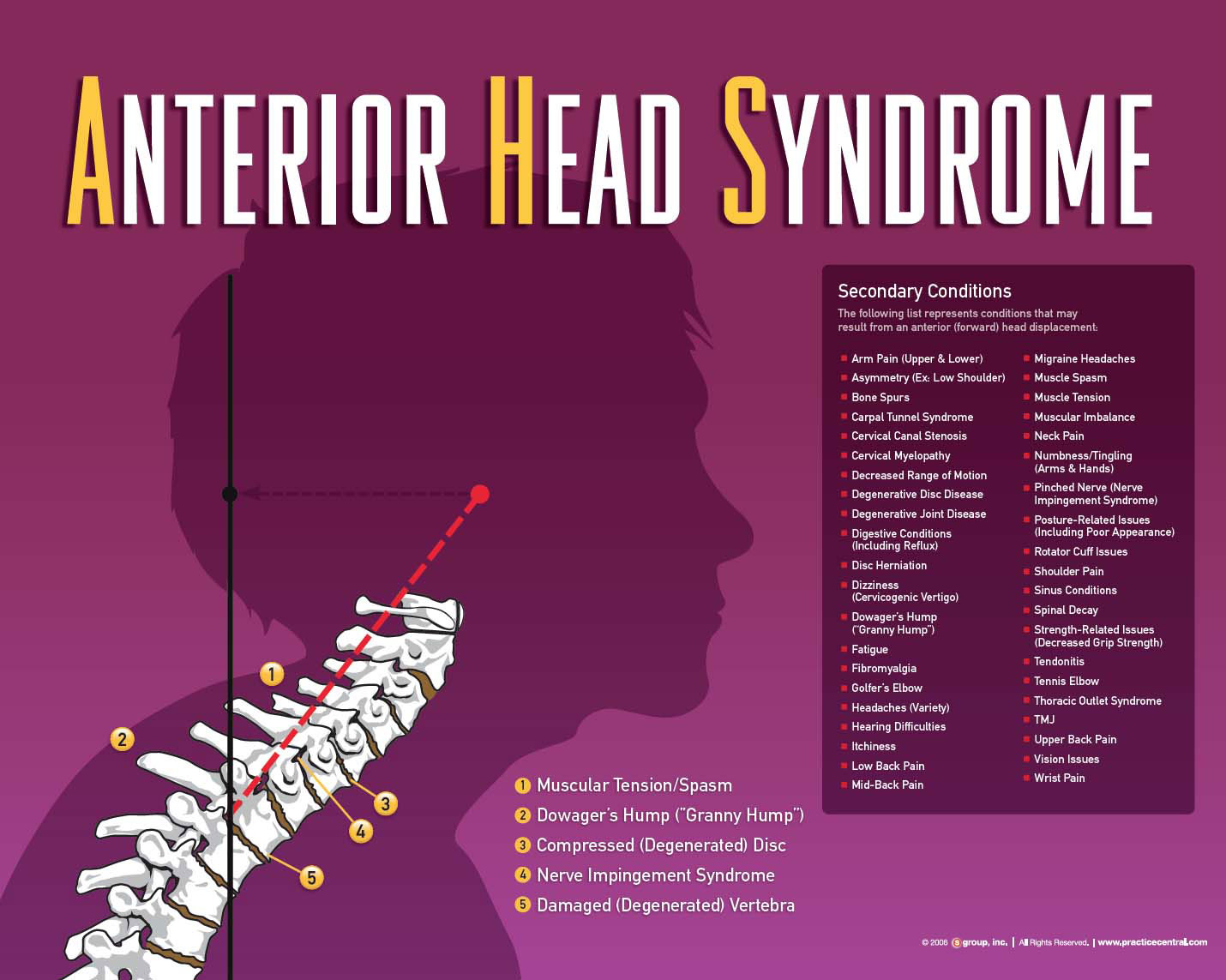 Anterior Head Syndrome facts
